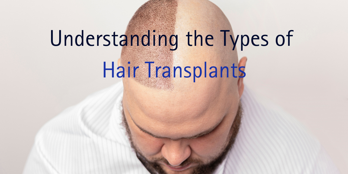 Understanding the Types of Hair Transplants