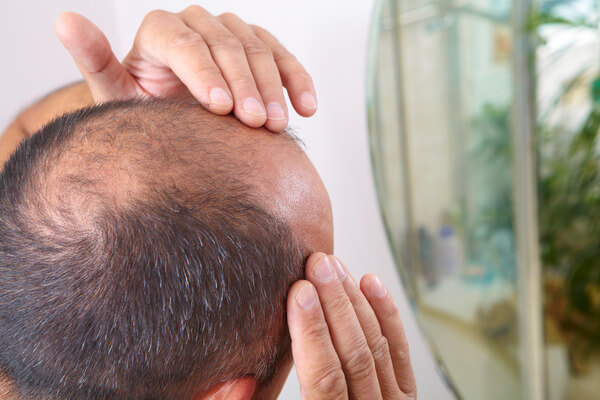 Non-Surgical Hair Loss Treatments