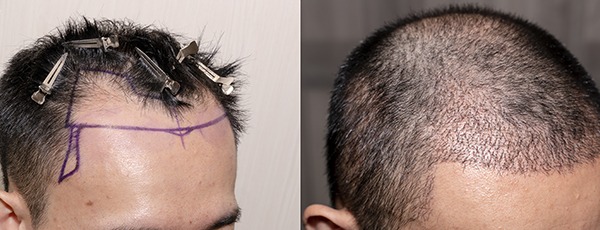 Hair Transplant Technology Advancements: The Future of Hair Restoration