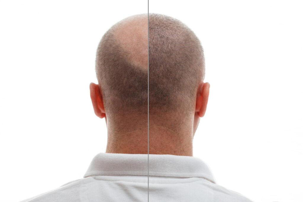 Long-Term Results of Hair Transplants: Maintaining Success